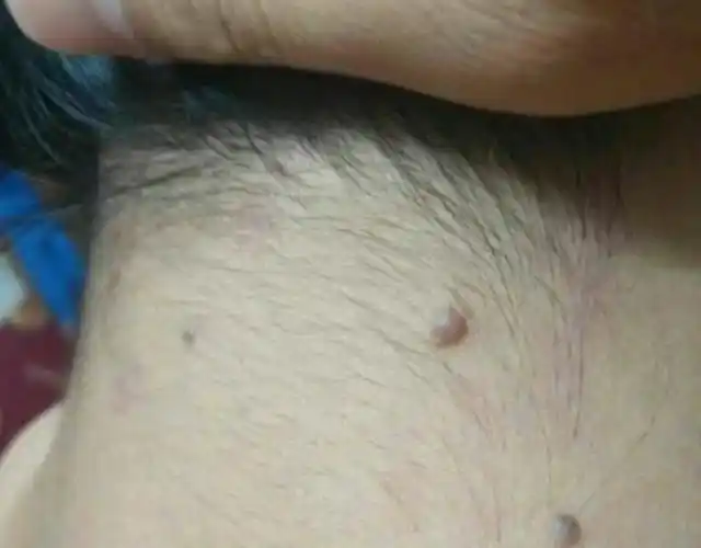 如果你仔细观察脖子后面,你会发现很多人的脖子后面都有黑痣,如果我们