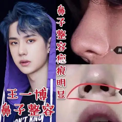 王一博整容鼻子疤痕明显_整容_疤痕_王一博_娱乐_明星娱乐资讯