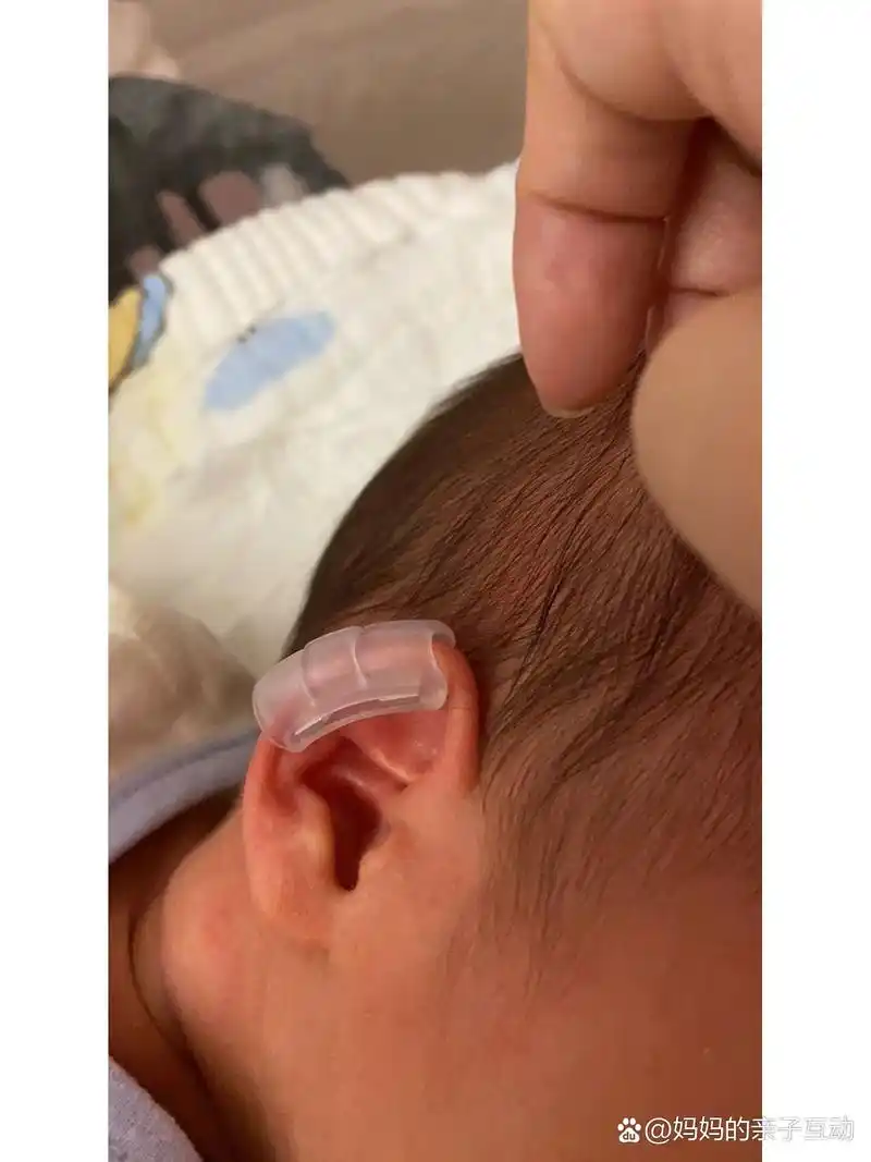 新生儿耳廓耳朵粘连变形 矫正过来了90 我生的时候 可能因为孩子在