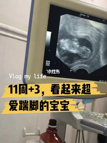 孕期b超11周3是个活泼的宝宝