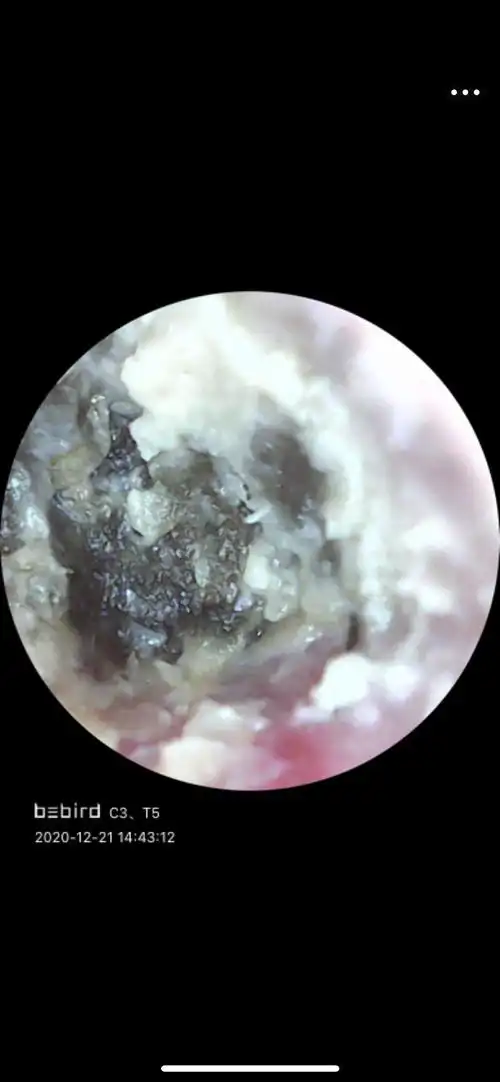 油耳朵腋臭的几率大吗