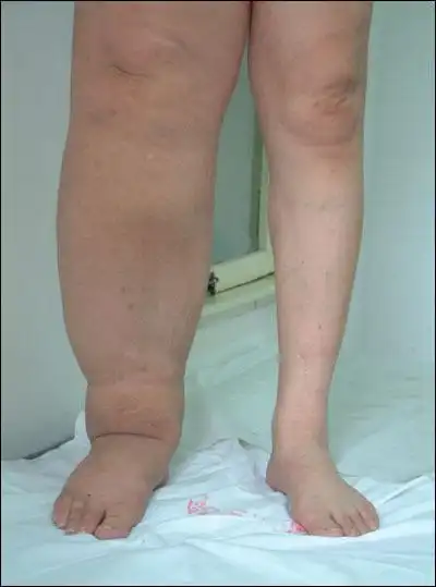 头面,四肢,腹背甚至全身浮肿,严重者还可伴有胸水.腹水等.