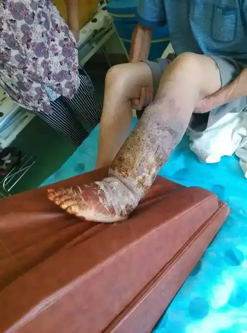 下肢橡皮腿样肿涨感治疗后消失 - 好大夫在线