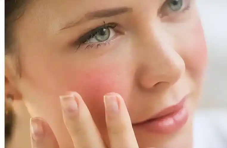 夏天容易脸红教你3个改善红脸蛋的技巧简单有效值得收藏