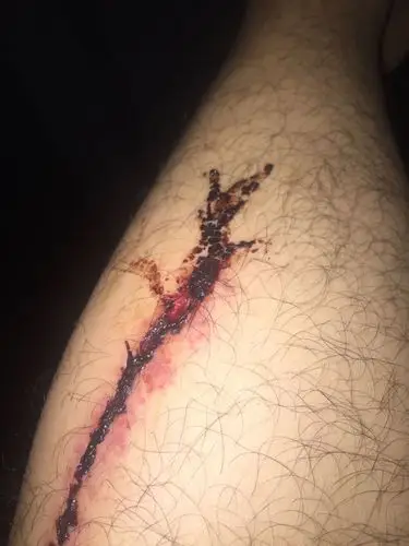 腿上伤口结疤了 能洗澡吗