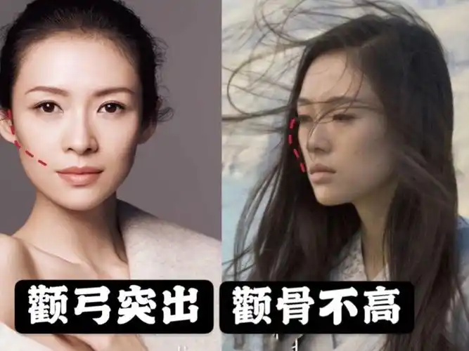颧骨高的姐妹,不要盲目想着去动骨头!(记得点关注哦)