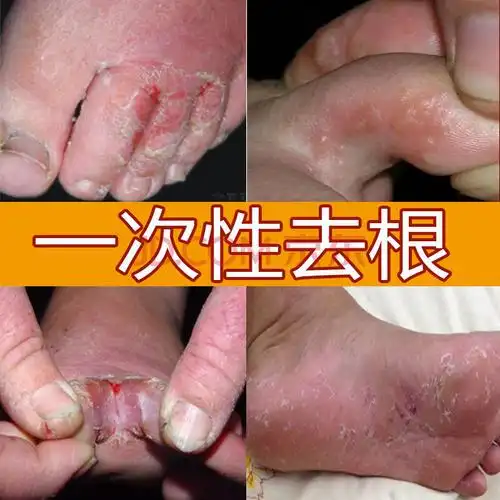 脚底脱皮脚气喷剂脚痒水泡脱皮烂脚丫止痒膏杀菌脚底起皮脚臭汗开裂