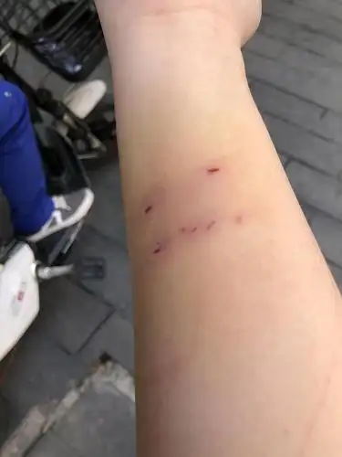 【讨论】姐妹们 被猫咬了该怎么办啊…(有图慎入)