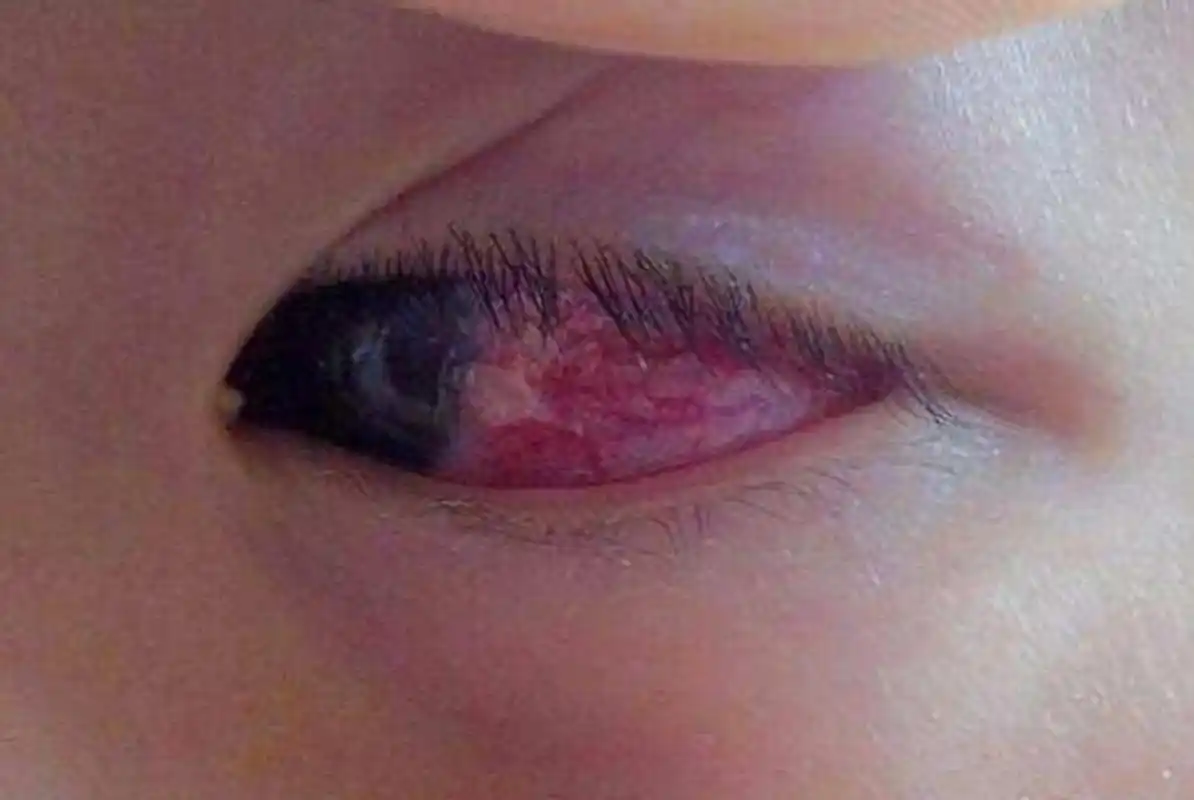 6月龄宝宝双眼近乎失明,引发悲剧的元凶很多家庭都有,速查速扔