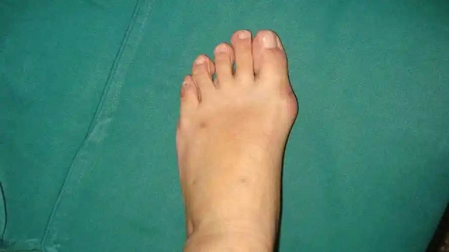 拇外翻术前术后对比照片-1 - 好大夫在线