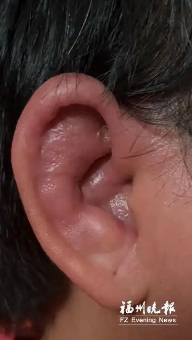 她的鼻梁塌陷,像马鞍,双耳耳廓肿得像菜花.