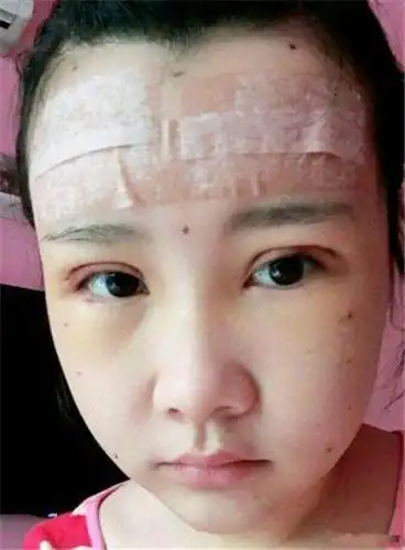 做自体脂肪填充 双眼皮后,我自拍一下,看到自己真的丑的想哭