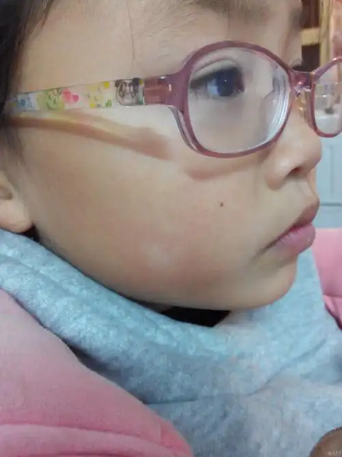小女孩脸上这白斑是什么啊是白癜风吗请各位老师帮忙看下谢谢