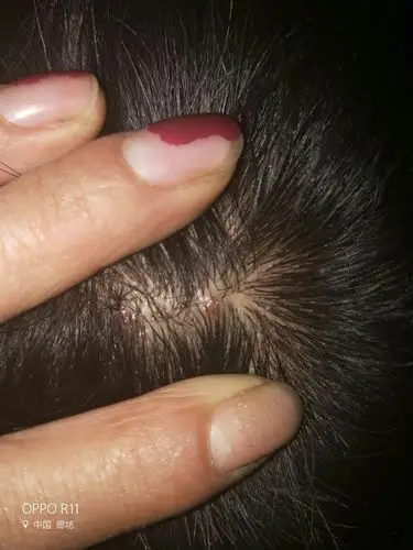 这头上是什么脓包呢?怎么治疗