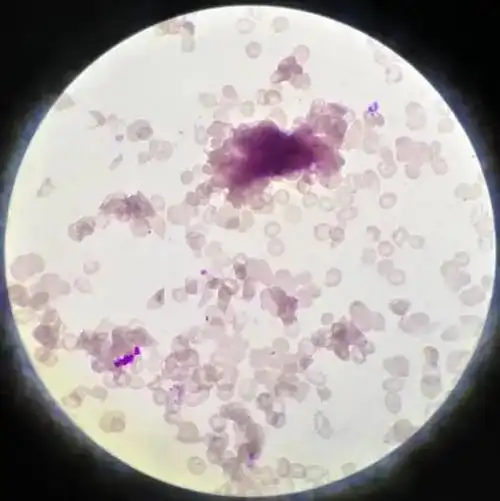 血涂片镜检:可见大量红细胞凝集.