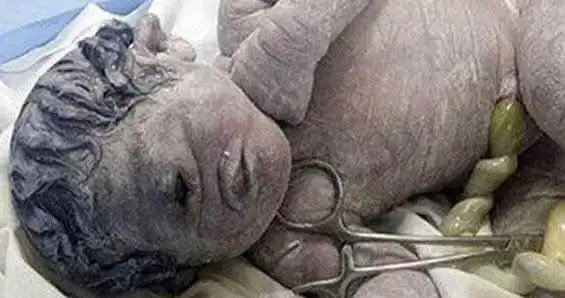 怪胎独眼婴儿五官严重变形医生无法判断病因家人也感到无奈