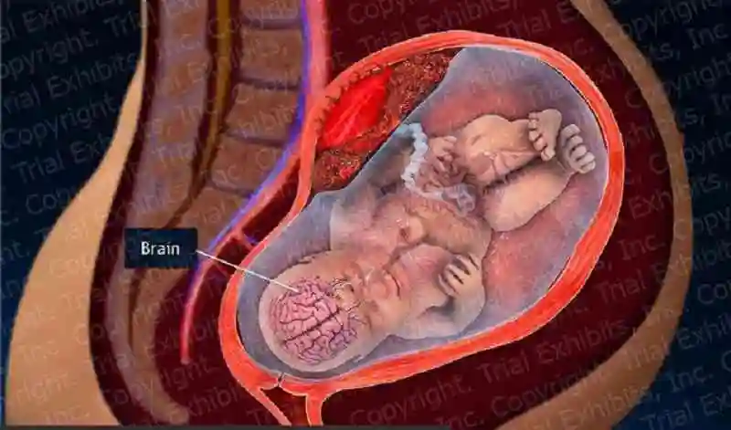 孕28周叶酸代谢是否会导致羊水破裂胎盘早剥