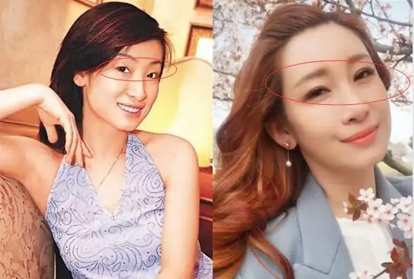 秦海璐割的双眼皮好大