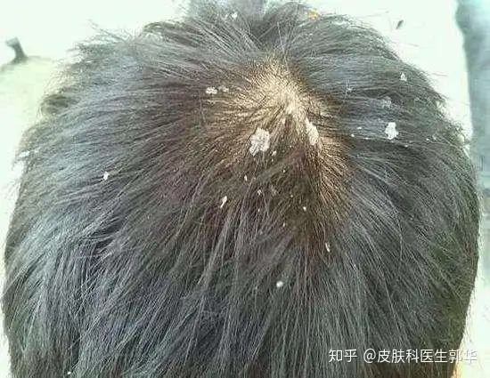 为什么头皮屑多 - 知乎