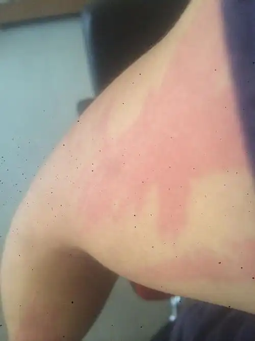 过敏过,原因是穿一件刚买回来的新衣服,麻料的,现在疙瘩没有了,全身