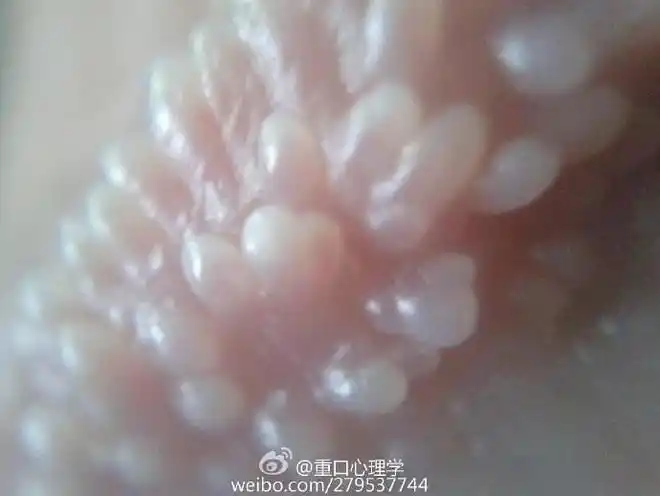 珍珠疹很多人的私处都有虽然无害但是影响美观你们快检查一下