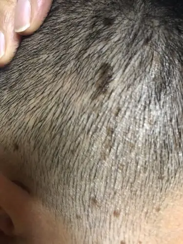 头部两耳边黑色斑点是什么