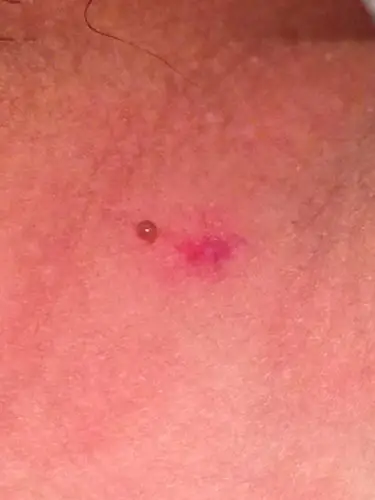 大腿根部 阴囊旁边 有黑色突起物 有点像泡 但又扣不掉.