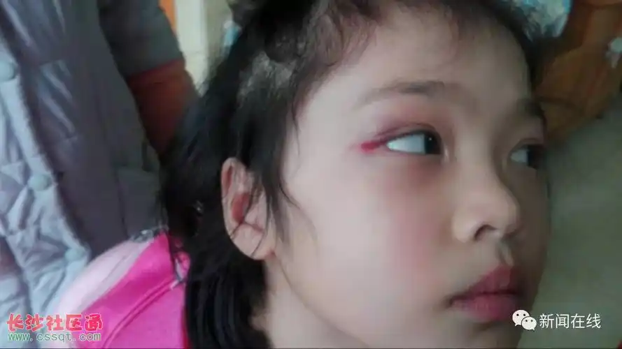 6岁女孩近视1200度 家长说在南宁市金贝贝幼儿园南湖碧园分园撞伤的