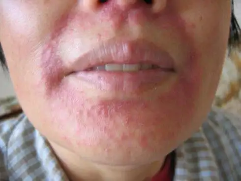 大多含糖皮质激素,诸如肤轻松,皮炎平,皮康王,派瑞松,艾洛松,皮康霜