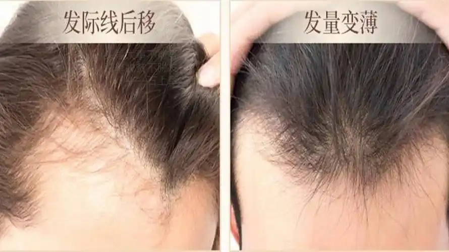 后悔没早点知道_头发_效果_头皮