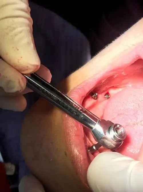 全口种植牙图片大全真人害怕者慎点