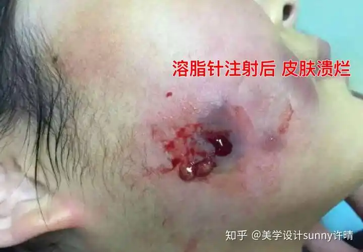 溶脂针是什么副作用大吗国内允许打吗溶脂针面部溃烂毁容
