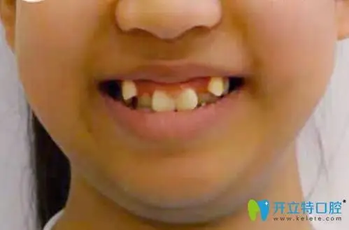 福州牙科虎牙小孩牙齿矫正发布时间: