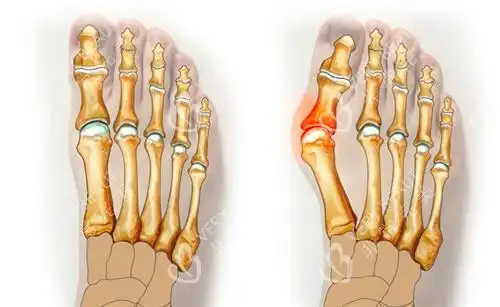 武汉哪里可以做大脚骨手术这几家开展大脚骨手术有优势