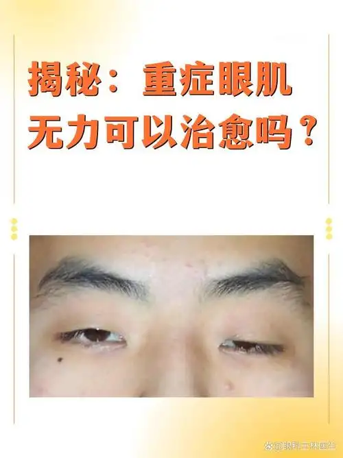 揭秘重症眼肌无力可以治愈吗