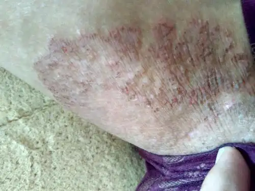 两边大腿生了这东西?很痒,还痒了很久 三个月也不好.