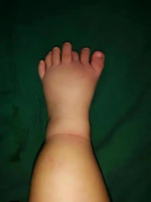 为什么做多趾前医生会让宝宝把脚洗干净