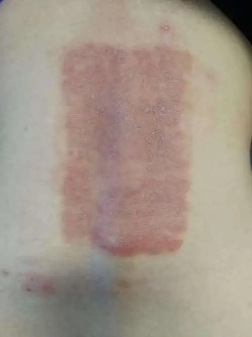 贴膏药贴出的皮肤病——接触性皮炎 (原创)