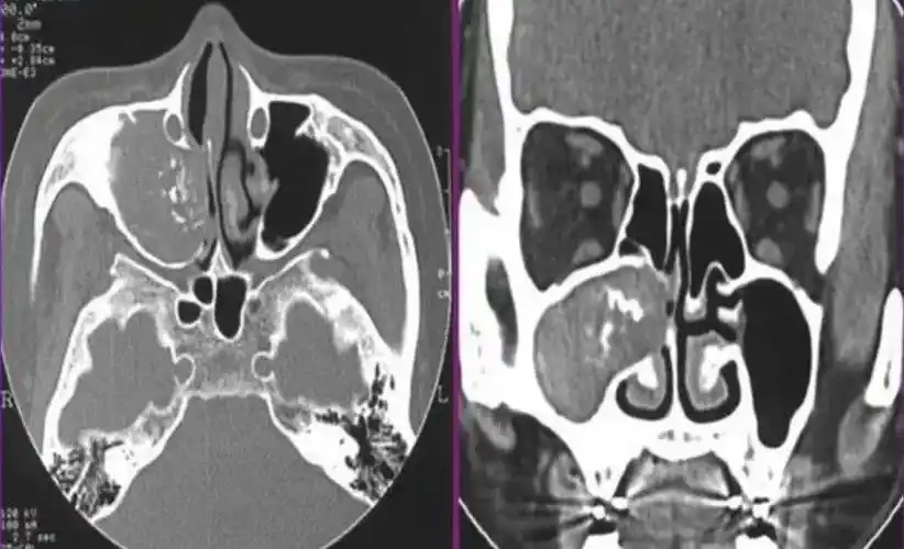 反复头痛鼻腔异味警惕真菌性鼻窦炎