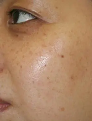 暗黄长斑的脸该如何是好 中药美白祛斑有强效