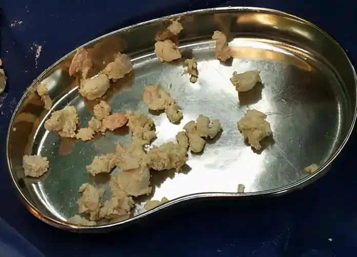 2.5l等于多少ml(痛风患者快收好) - 青木春