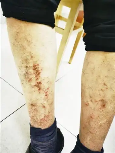 瘙痒难忍 越抓越痒 秋冬季节乏脂性湿疹进入高发期