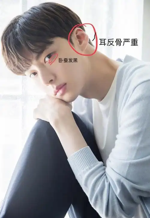 下图可以看出,安宰贤的99耳骨异常,不同于一般人的耳廓反骨十分明显