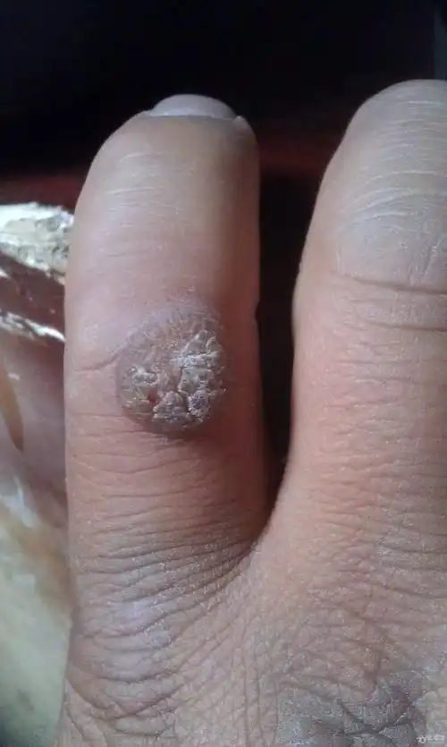 求助有经验的同仁看看这刺瘊怎么治疗