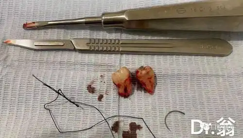 近期5例智齿拔除案例图片分享