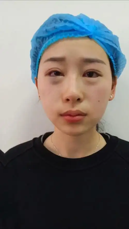 下睑下至术加开外眼角术后当天