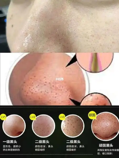 黑头粉刺用什么好祛除一起来看看