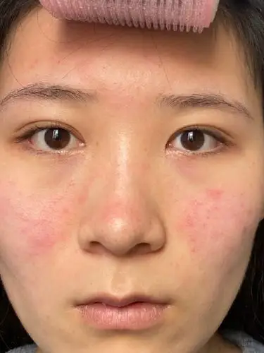 这几天复发后脸上炎症反_圈子-新氧美容整形