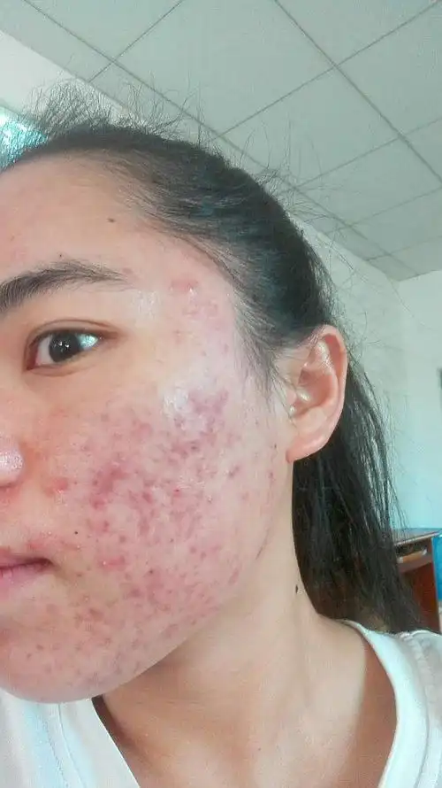 【求助】我脸这样一年了,之前满脸痘痘,现在痘痘.