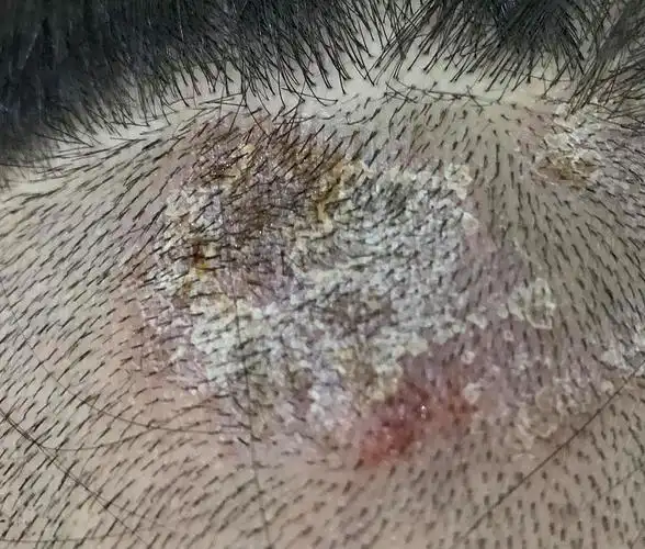 有图慎入!快被折磨疯掉了,愈来愈严重的脂溢性皮炎